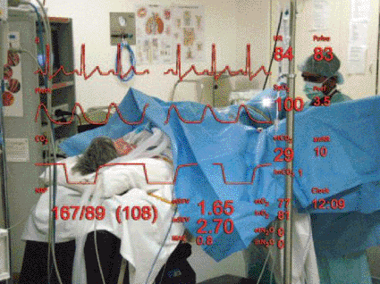 Image: A simulated image showing the participant’s view while monitoring the patient’s vital signs with the HMD (photo courtesy University of Queensland).